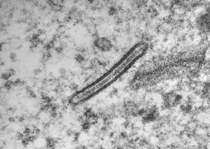 M,1y. | Birbeck granule (X-granule) - skin, histiocytosis X M,1y. | Birbeck granule (X-granule) - skin, histiocytosis X